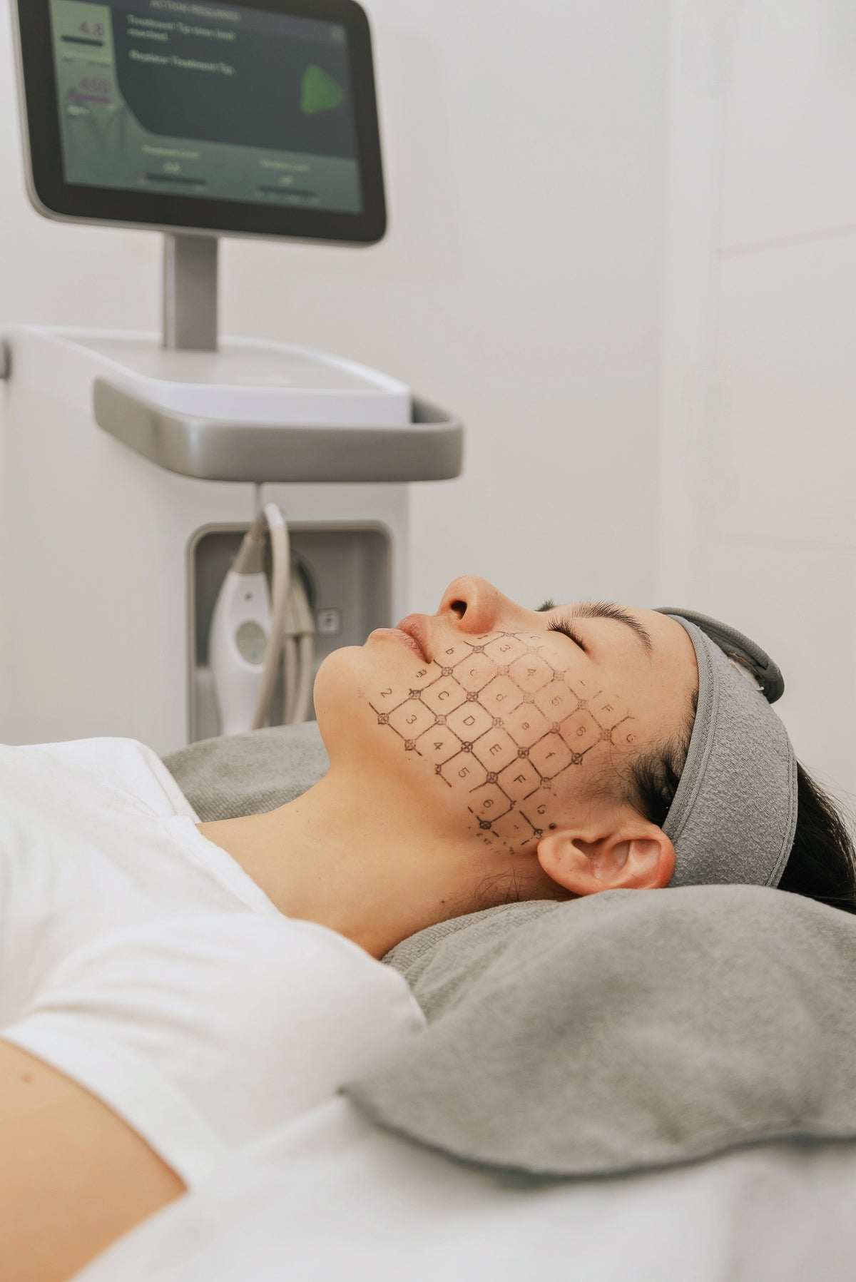 Thermage FLX at BioPlus International