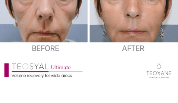 Dermal Fille ultra deep after & before