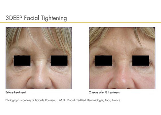 3DEEP face tightening