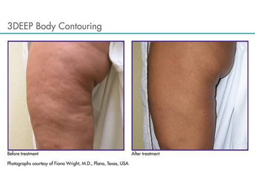 3DEEP Body Contouring