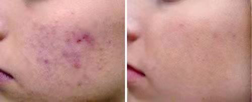 laser pigmentation removal