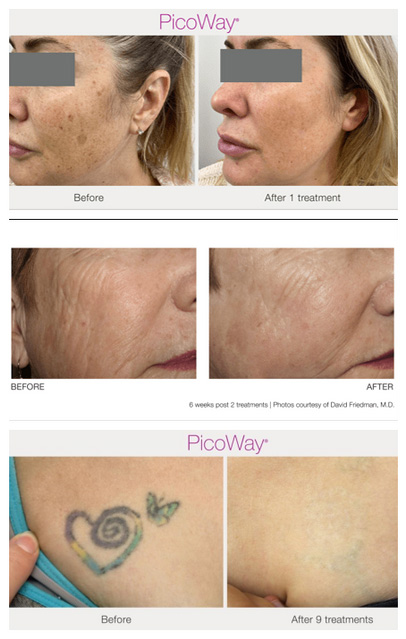 skin rejuvenation treatment